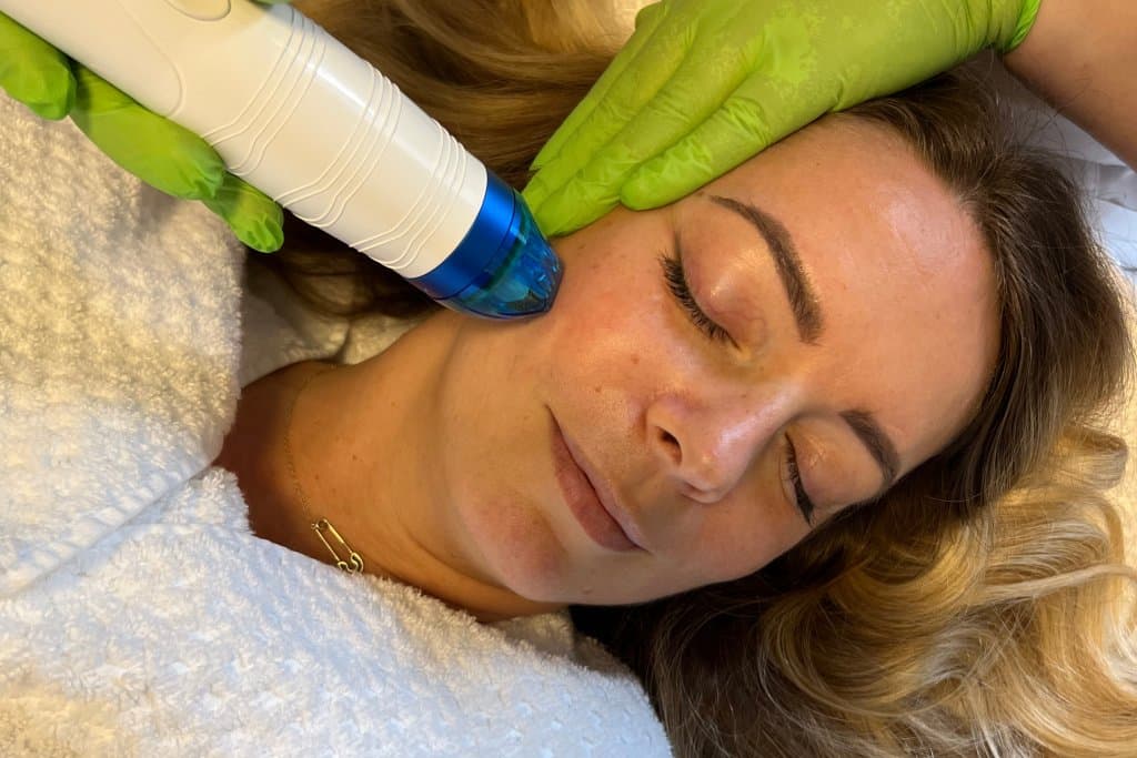 Microneedling